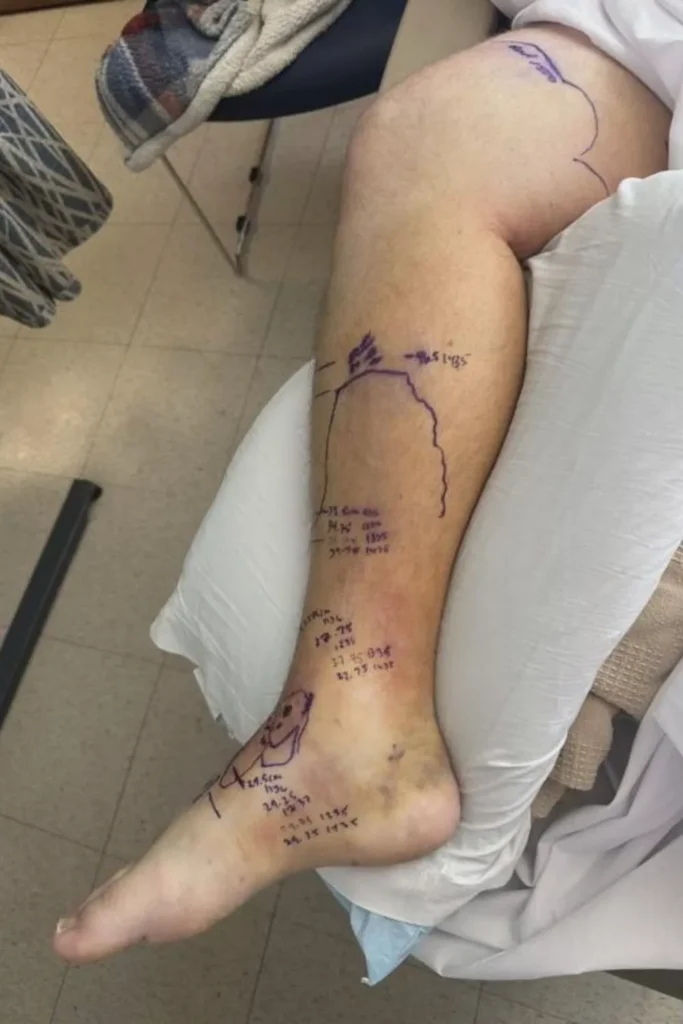 Man Bitten Twice by Rattlesnake in His Parents' Oroville Yard